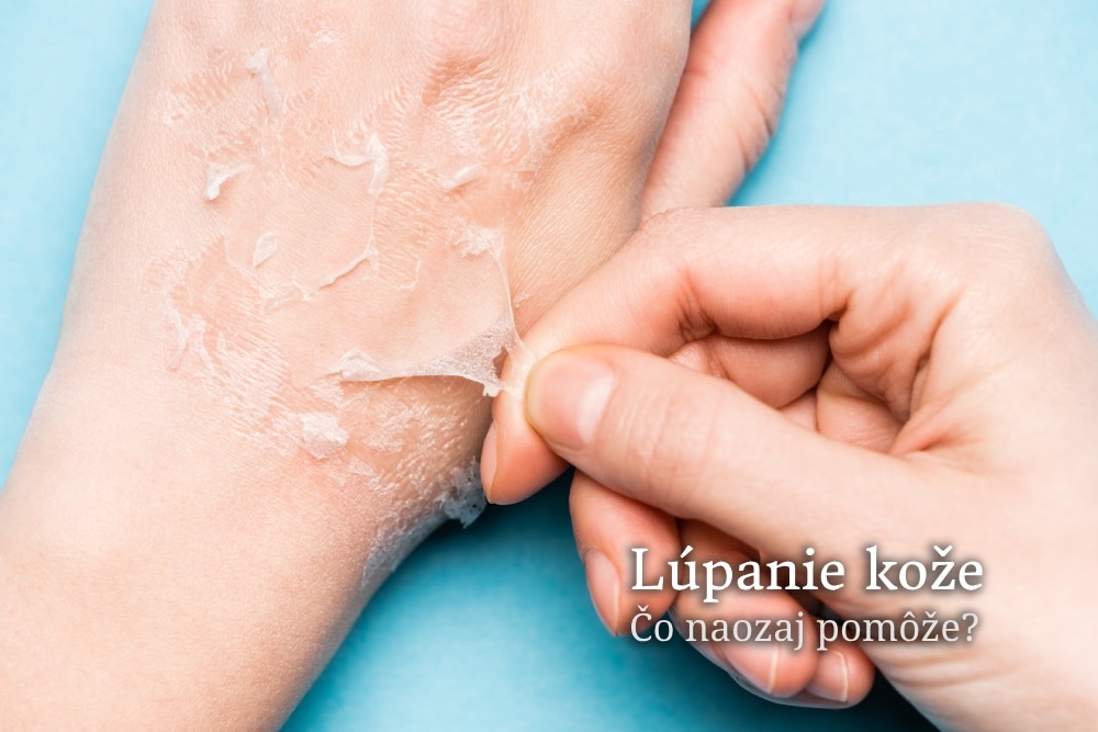 lúpanie kože