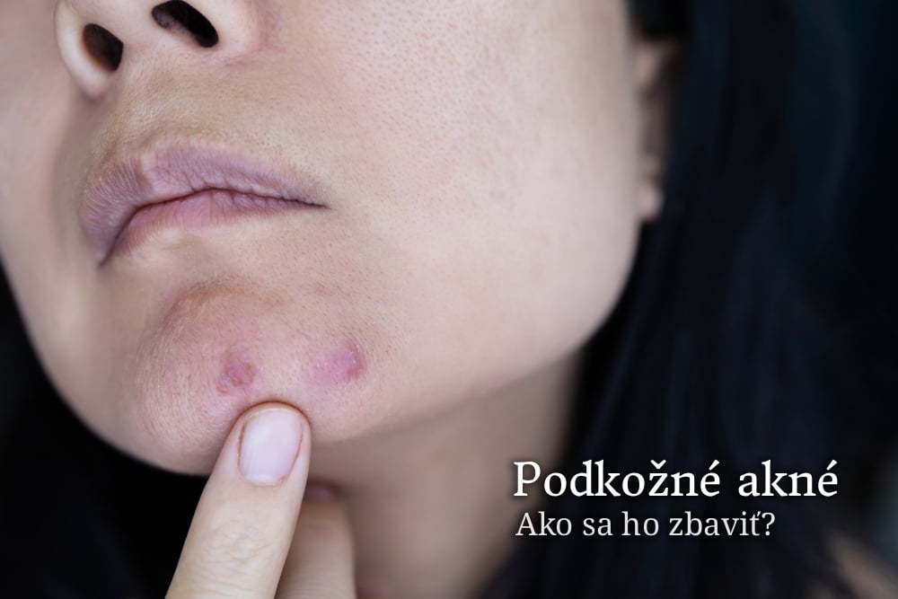 podkožné akné